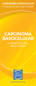 carcinoma basocelular
