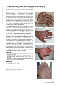 Lesões bolhosas palmo-plantares pós-quimioterapia - Galicia