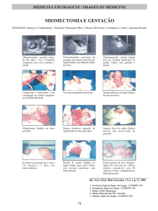miomectomia e gestação - Portal de Revistas PUC SP