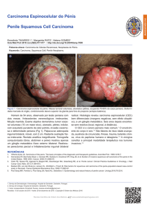 Carcinoma Espinocelular do Pénis Penile Squamous Cell Carcinoma