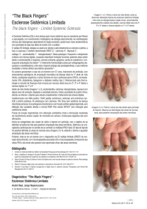 “The Black Fingers” Esclerose Sistémica Limitada - Galicia