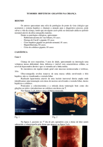 TUMORES HEPÁTICOS GIGANTES NA CRIANÇA RESUMO Os