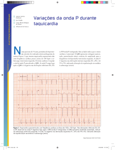 Variações da onda P durante taquicardia