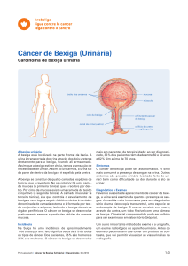 Câncer de Bexiga (Urinária) - Carcinoma de bexiga